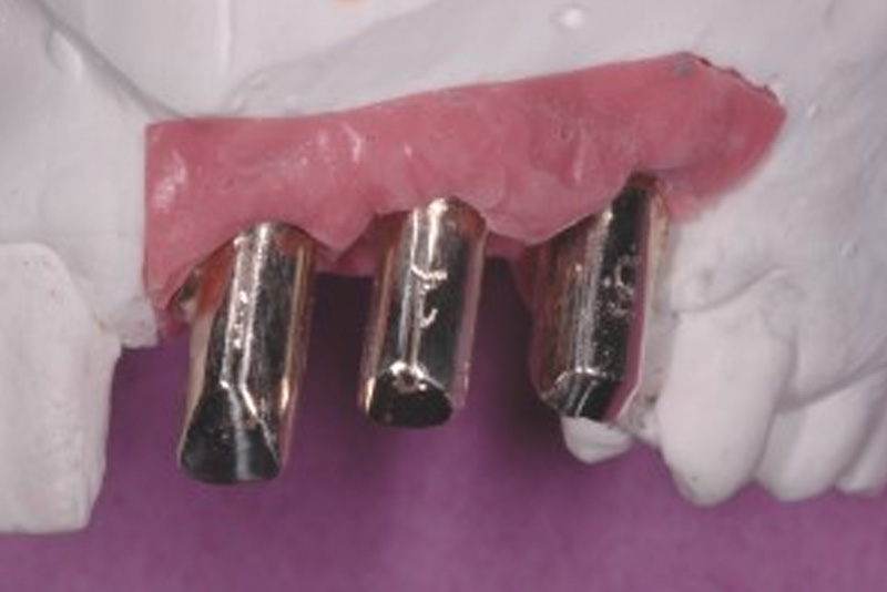 Dental Treatment requiring several specialists l Prosthodontist