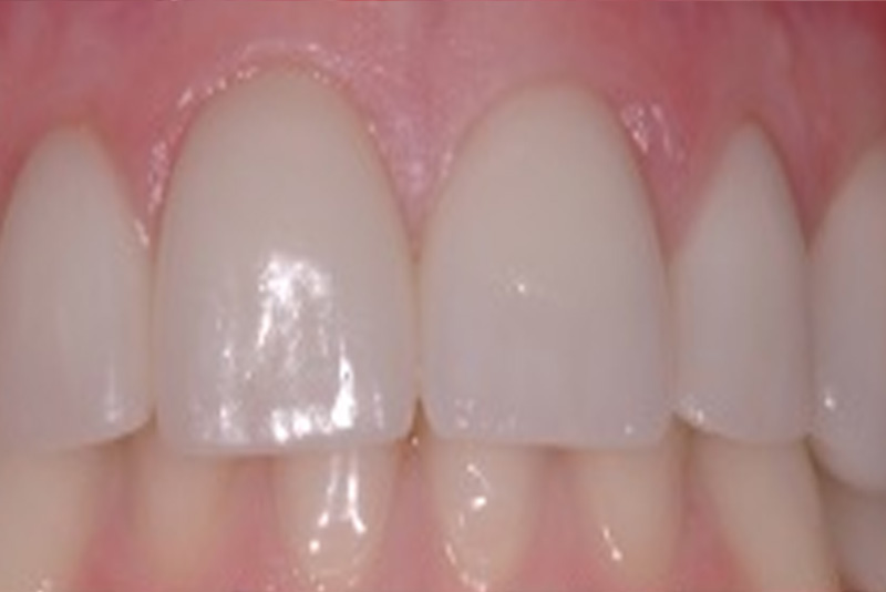 sd1 Teeth
